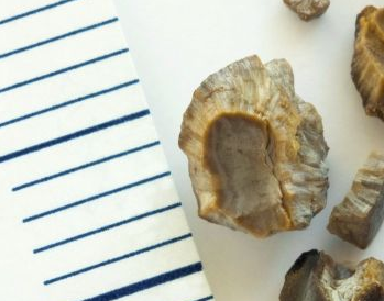 经常喝可乐会得肾结石吗 结石该如何治疗